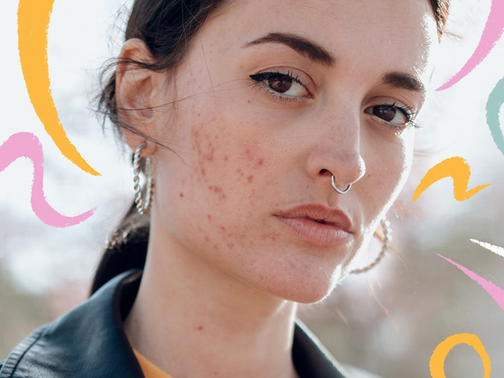 The Best Way to Heal Acne from Mental Stress