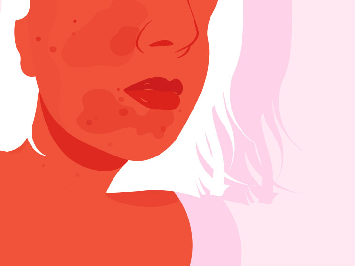 I'm Beautiful Because of My Rosacea, Not Despite It
