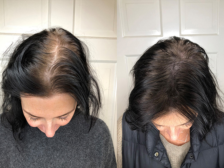 How Scalp Tattooing Can Give You a 'Full' Head of Hair