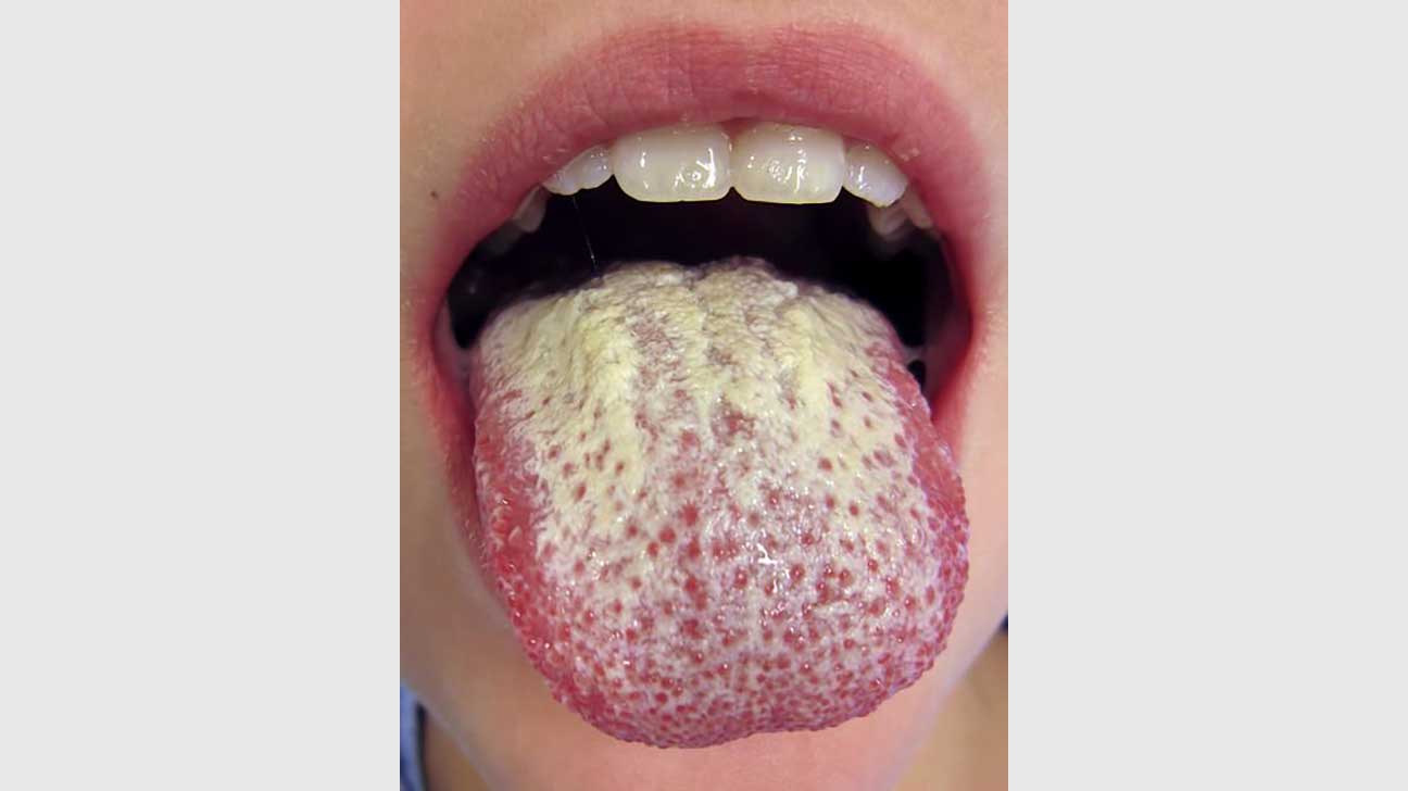 Hairy Tongue Cure
