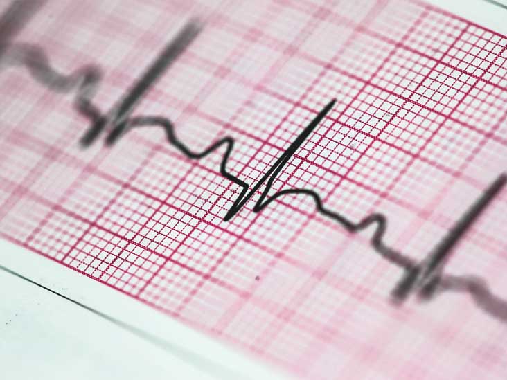 An Overview of Atrial Fibrillation