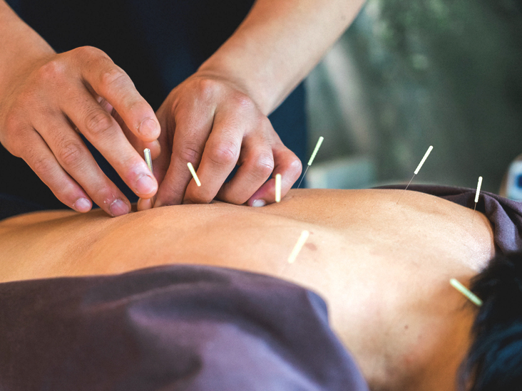 Can Acupuncture Help Treat Your Rheumatoid Arthritis?