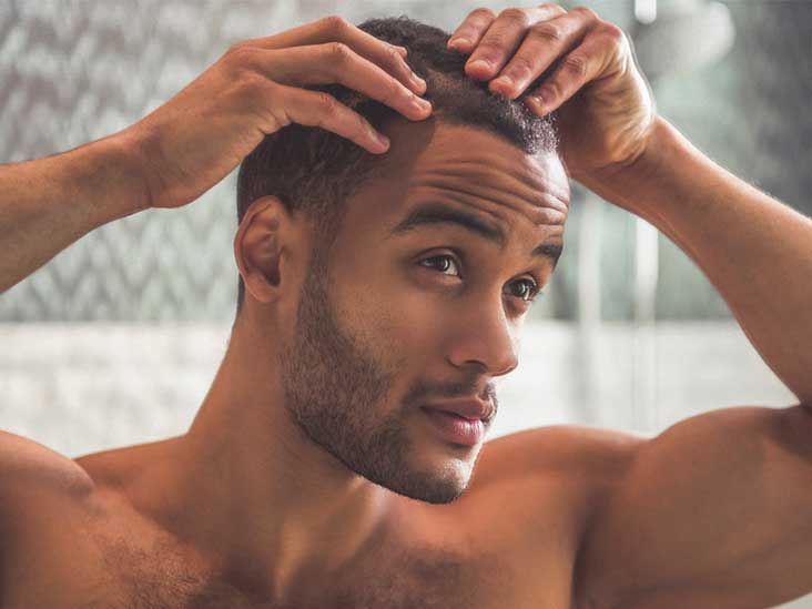Receding Hairline Stages Causes Treatments  More  Metropolis TruHealth  Blog