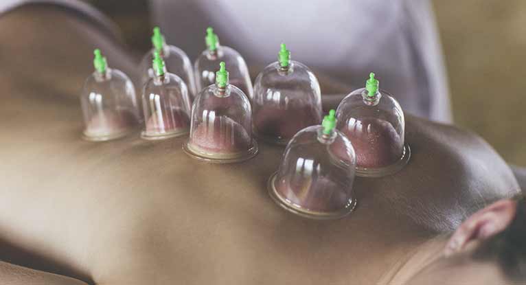 Image result for cupping