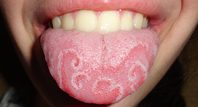 Image result for tongues get weird bumps blogspot.com