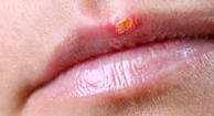 Photo of a canker sore on a woman&amp;amp;amp;amp;amp;amp;amp;amp;amp;amp;amp;amp;amp;amp;amp;#039;s lip.