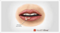 Medical drawing of a mouth ulcer caused by herpes stomatitis.