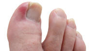 Photo of a ingrown toenail on the big toe.