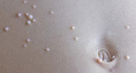 Photo of molluscum contagiosum on the stomach.