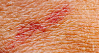 Photo of stasis dermatitis.