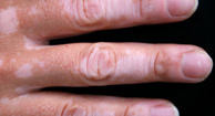 Photo of vitiligo patches on a hand.