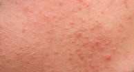 Photo of acne (pimples).