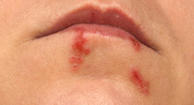 Photo of cold sores on a woman&amp;amp;amp;amp;amp;amp;amp;amp;amp;amp;amp;amp;amp;amp;amp;#039;s mouth.