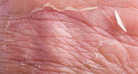 Photo of eczema.