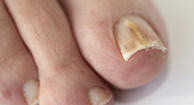 Photo of a funal nail infection on the big toe.