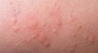 Photo of hives on skin.
