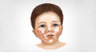 Acrodermatitis childhood skin condition
