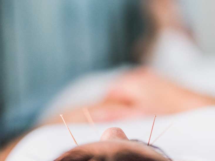 Acupuncture for Depression: Does It Work?
